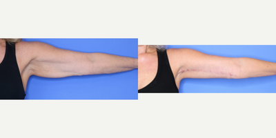 Arm Lift before and after photo