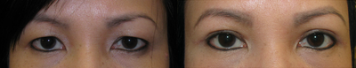 Double Eyelid Surgery before and after photo
