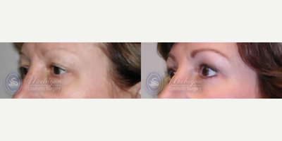 Eyelid Surgery before and after photo