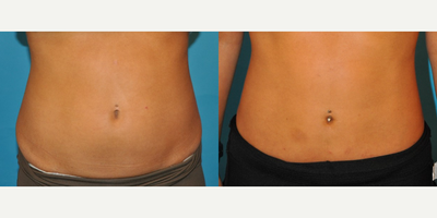Liposuction before and after photo