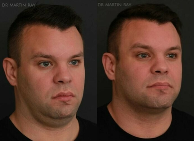 PRP Injections before and after photo