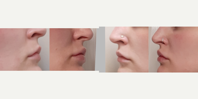 Restylane Kysse before and after photo