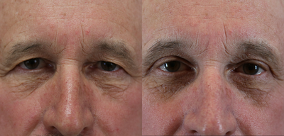Brow Lift before and after photo
