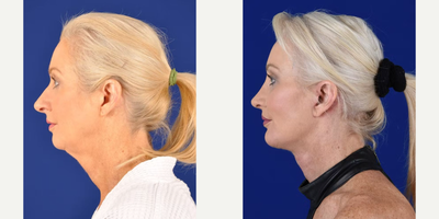 Facelift before and after photo
