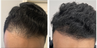 FUE Hair Transplant before and after photo