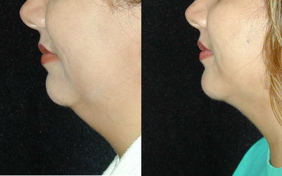 Genioplasty before and after photo