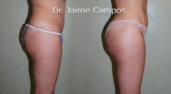 Brazilian Butt Lift before and after photo