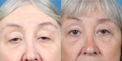 Eyelid Surgery before and after photo