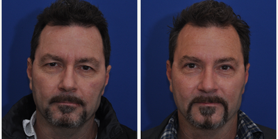 Facelift before and after photo