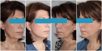 Facelift before and after photo