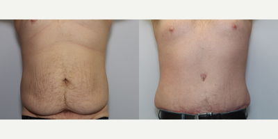 Male Tummy Tuck before and after photo