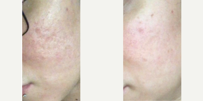 PRP Injections before and after photo