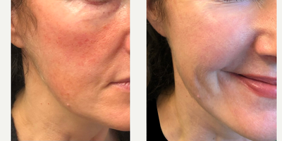 CO2 Laser before and after photo