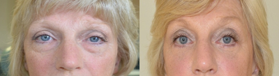 Eyelid Surgery before and after photo