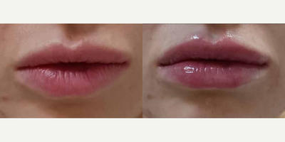 Lip Fillers before and after photo