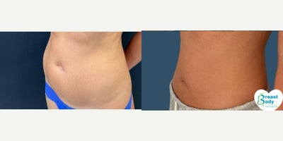 Liposuction before and after photo