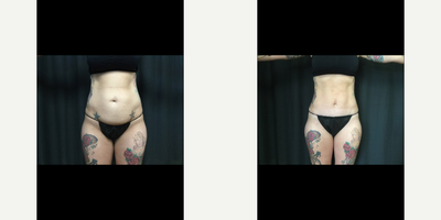 Tummy Tuck before and after photo