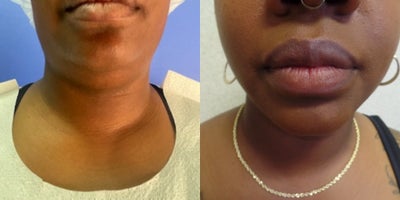 Vaser Liposuction before and after photo