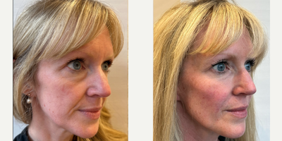 Cheek Fillers before and after photo