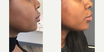 Kybella before and after photo