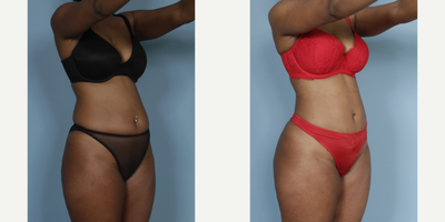 Liposuction before and after photo