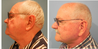 Skin Rejuvenation before and after photo