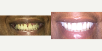 All-on-4 Dental Implants before and after photo