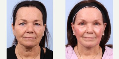 Eyelid Surgery before and after photo