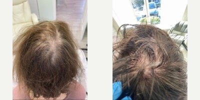 Hair Loss Treatment before and after photo