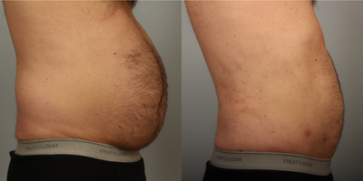 Liposuction before and after photo