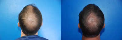 PRP for Hair Loss before and after photo