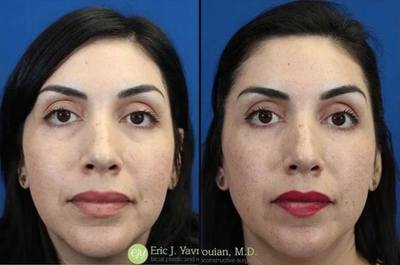 Restylane before and after photo