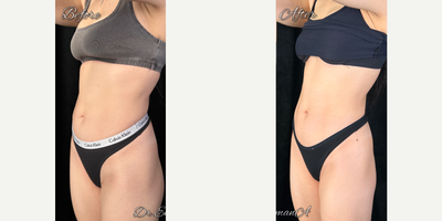 Skin Tightening before and after photo