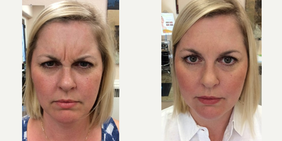 Botox before and after photo