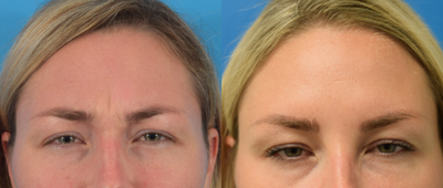 Dysport before and after photo