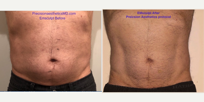 Emsculpt before and after photo