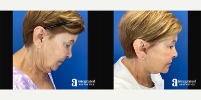 Facelift before and after photo