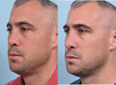 Revision Rhinoplasty before and after photo