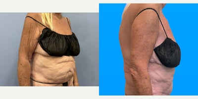 Arm Lift before and after photo