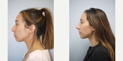 Asian Rhinoplasty before and after photo