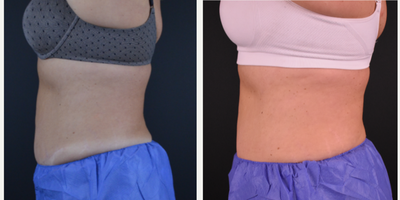 CoolSculpting before and after photo