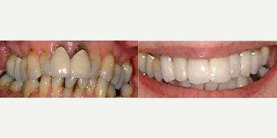 Dental Crown before and after photo