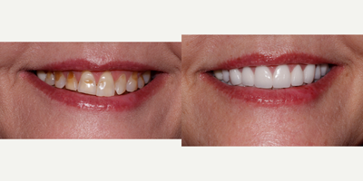 Dental Crown before and after photo