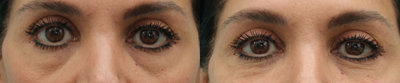 Dermal Fillers before and after photo