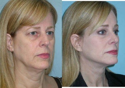 Facelift before and after photo