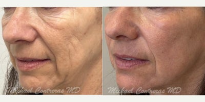 Laser Resurfacing before and after photo