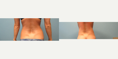 Liposuction before and after photo