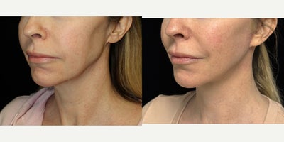 Mini Neck Lift before and after photo