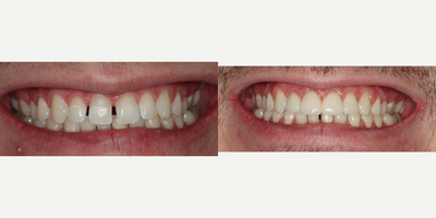 Porcelain Veneers before and after photo