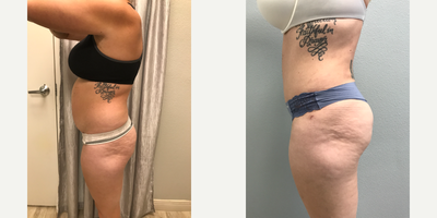 Tummy Tuck before and after photo
